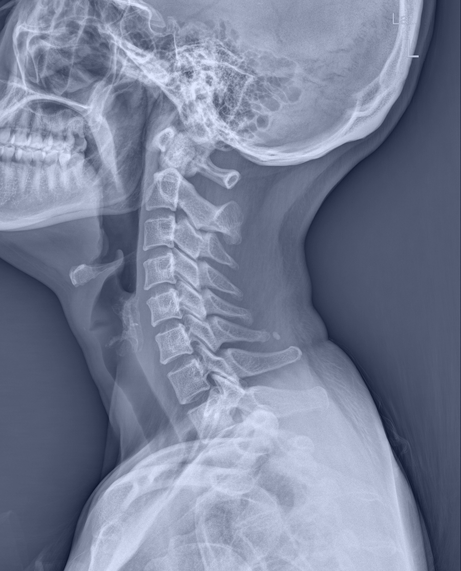 radiographie d'un cou, montrant les os cervicales