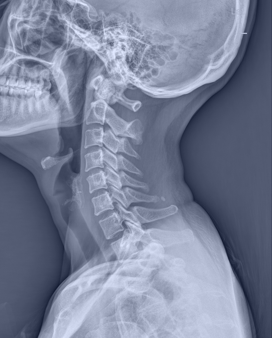 radiographie d'un cou, montrant les os cervicales